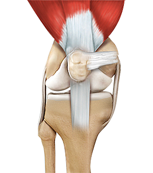 Quadriceps Tendon Rupture