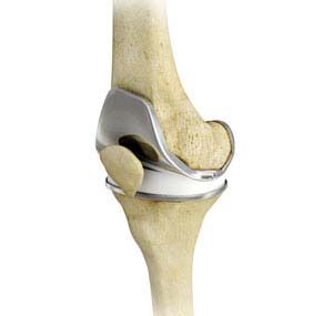 Revision Hip Replacement